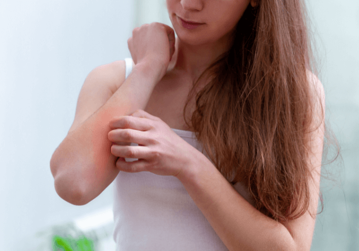 Te confrunți cu eczeme? Iată principalele tipuri și ce tratament naturist este recomandat 1 despre eczeme