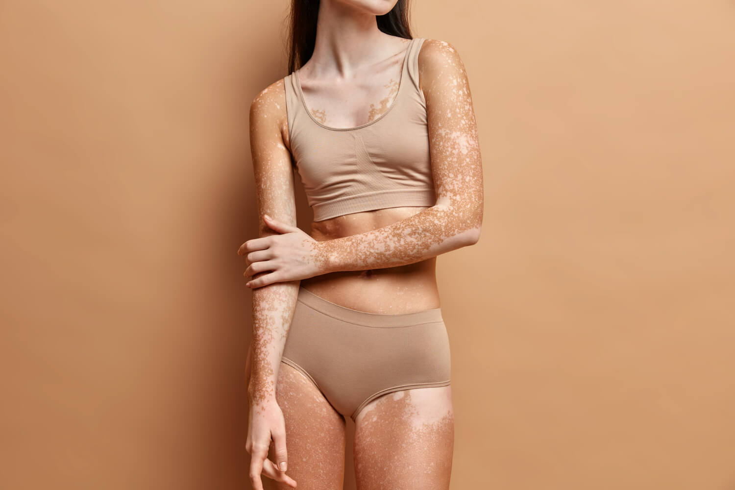 vitiligo boala autoimuna