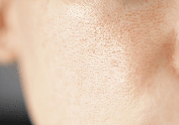 orii dilataţi – cauze şi remedii pentru pori dilataţi