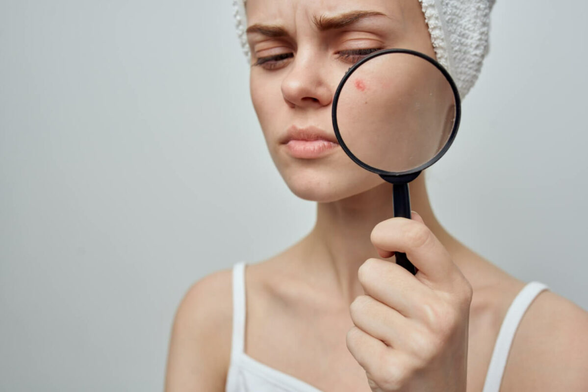 Acneea mecanica: Cauzele aparitiei, manifestari si metode de preventie 1 acnee mecanica