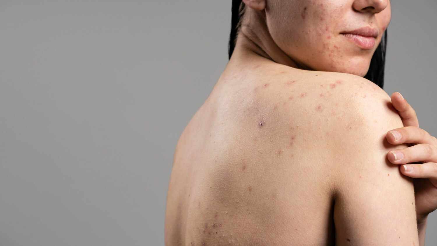 cicatrici acnee cum apar cicatrici acnee cum apar