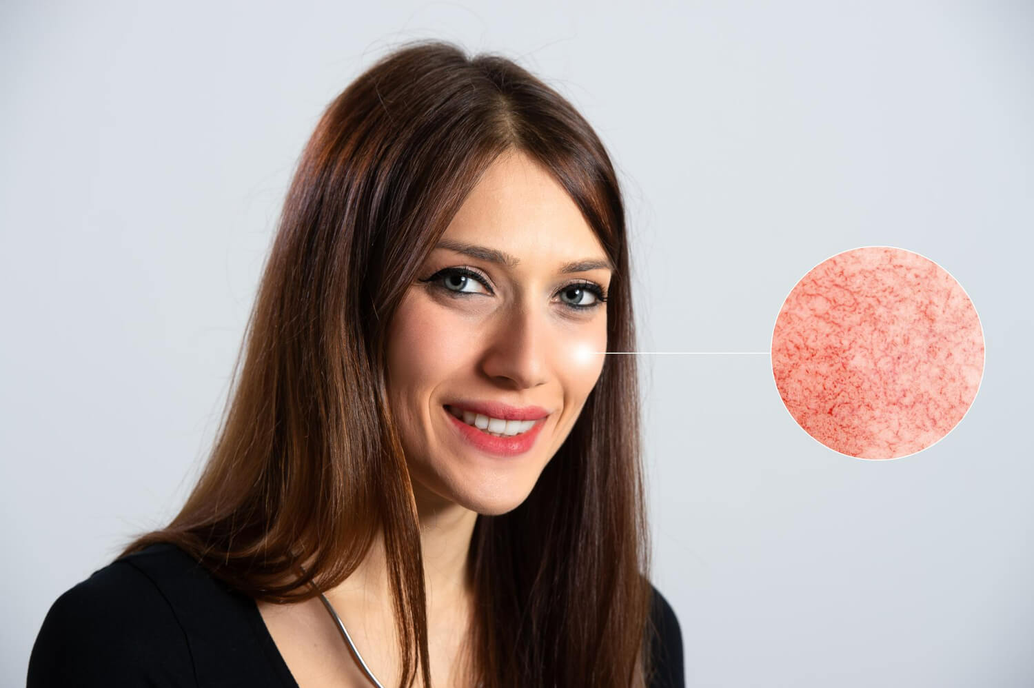 tratament cuperoza tratament cuperoza