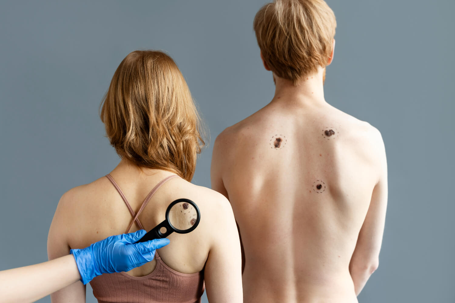 ce este cancerul de piele ce este cancerul de piele