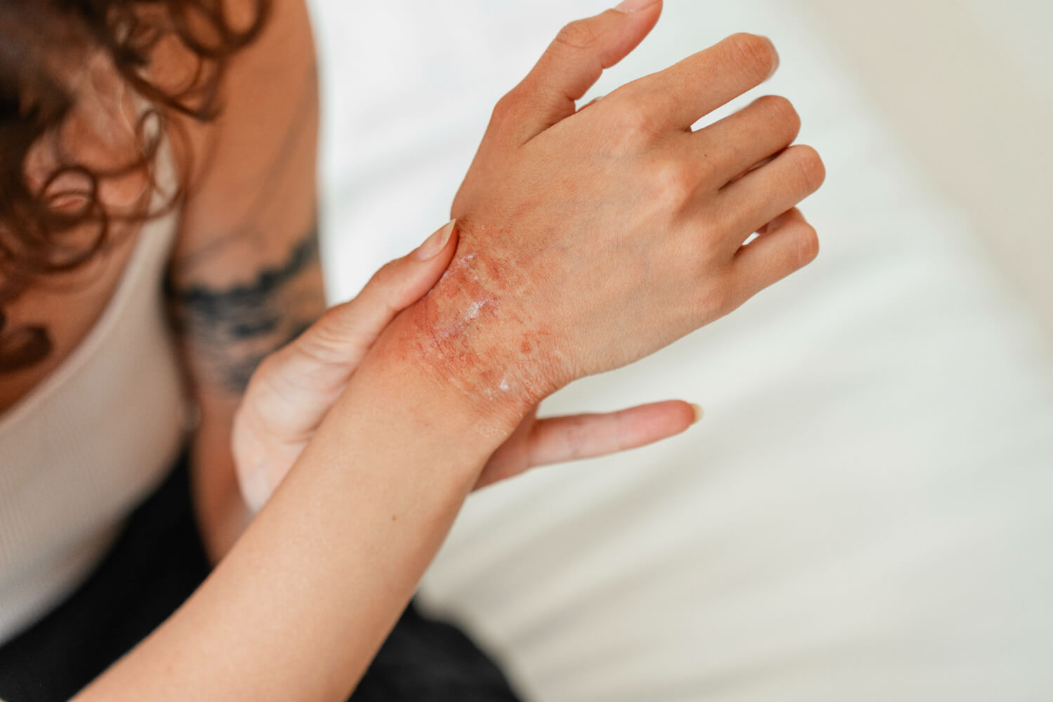 tipuri de eczeme tipuri de eczeme