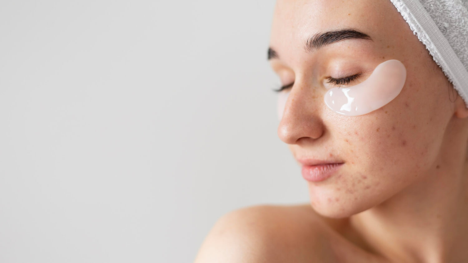 ingrijirea tenului acneic