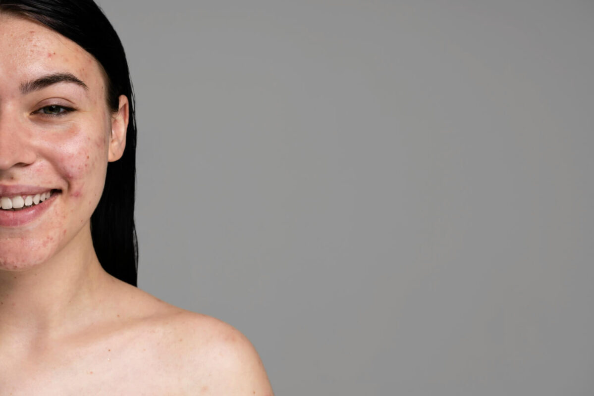 nutrienti pentru piele acneica