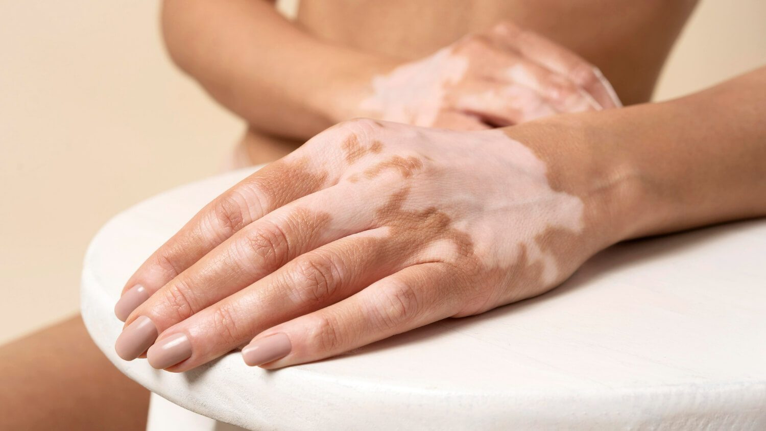 tratamente vitiligo tratamente vitiligo