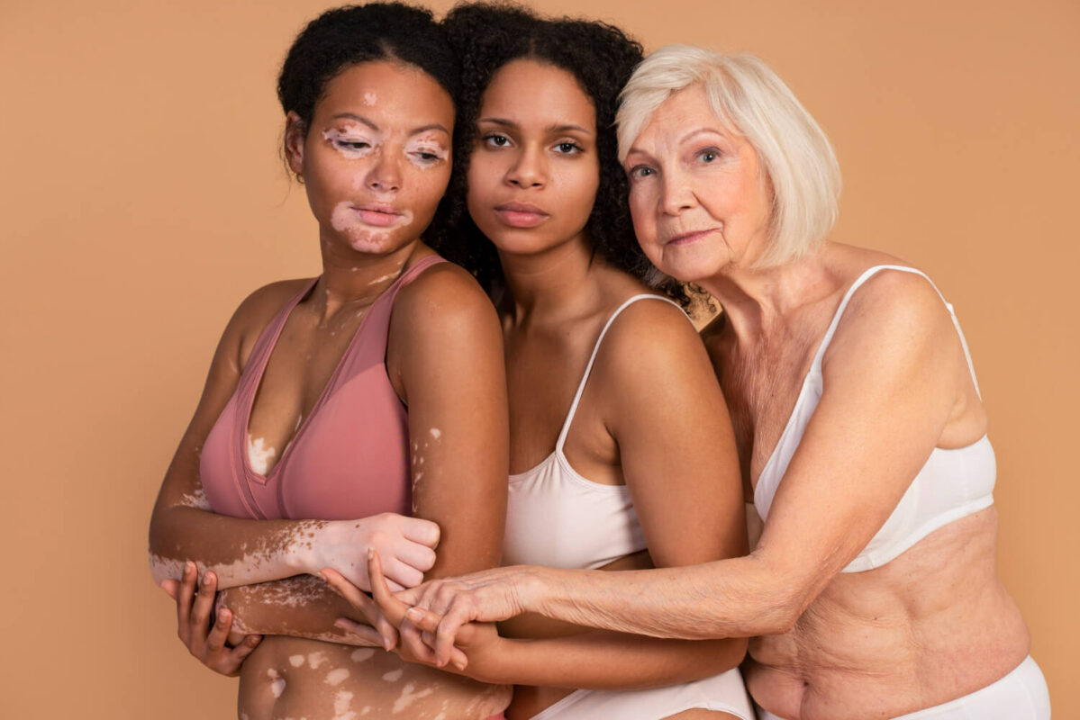 Vitiligo, frumusete unica: Cum sa te simti bine in propria piele 1 despre vitiligo