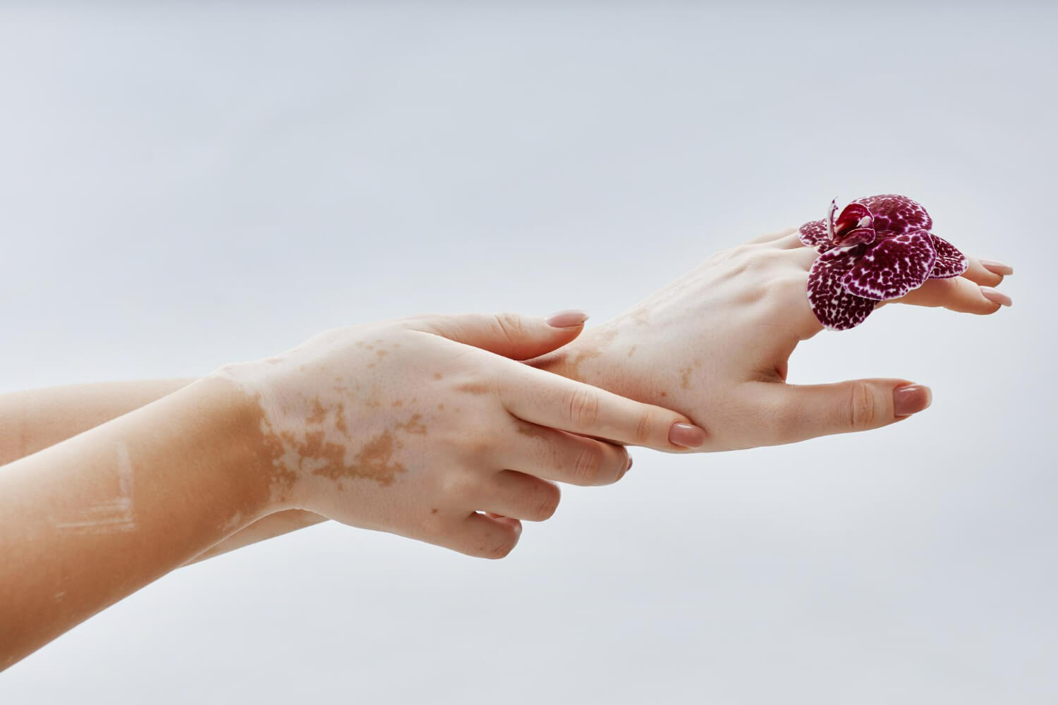 ce este vitiligo ce este vitiligo