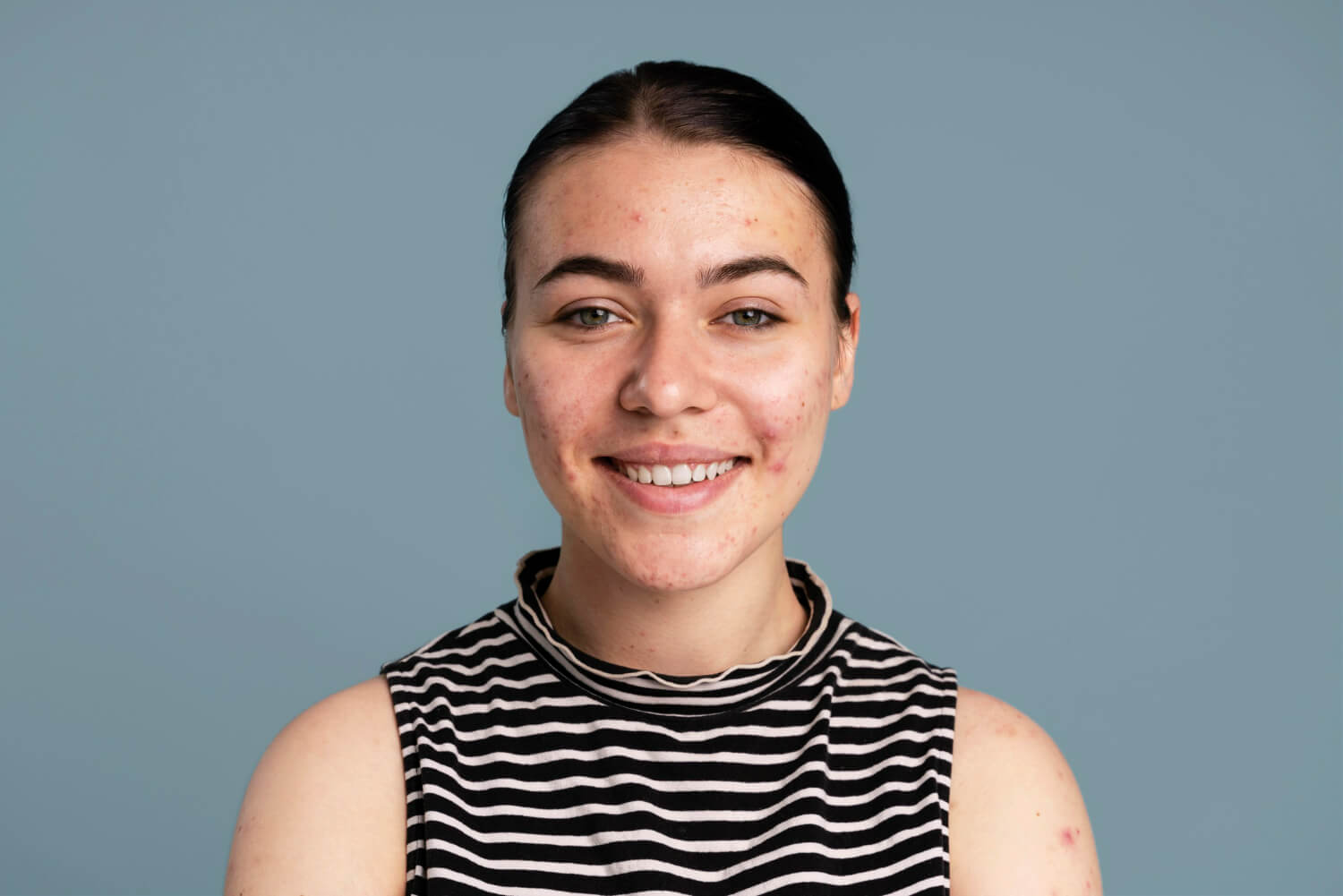 tratament acnee tratament acnee