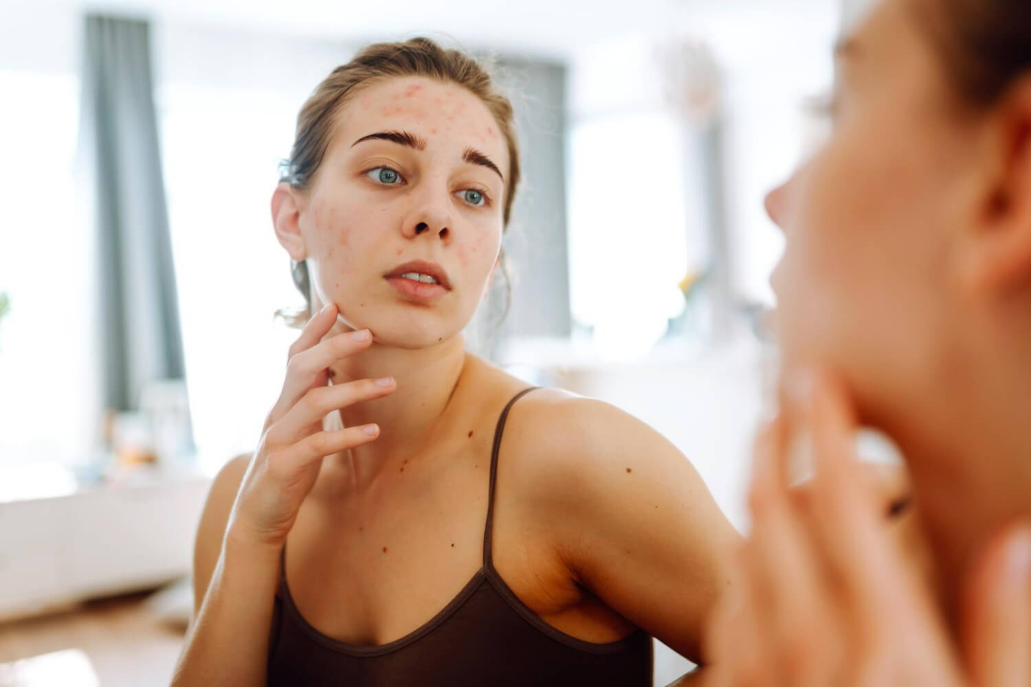 ce este acneea hormonala