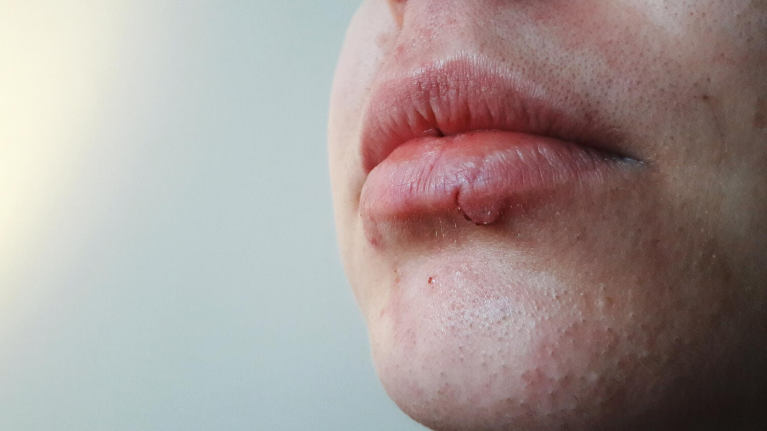 dermatita perioarala cauze dermatita perioarala cauze