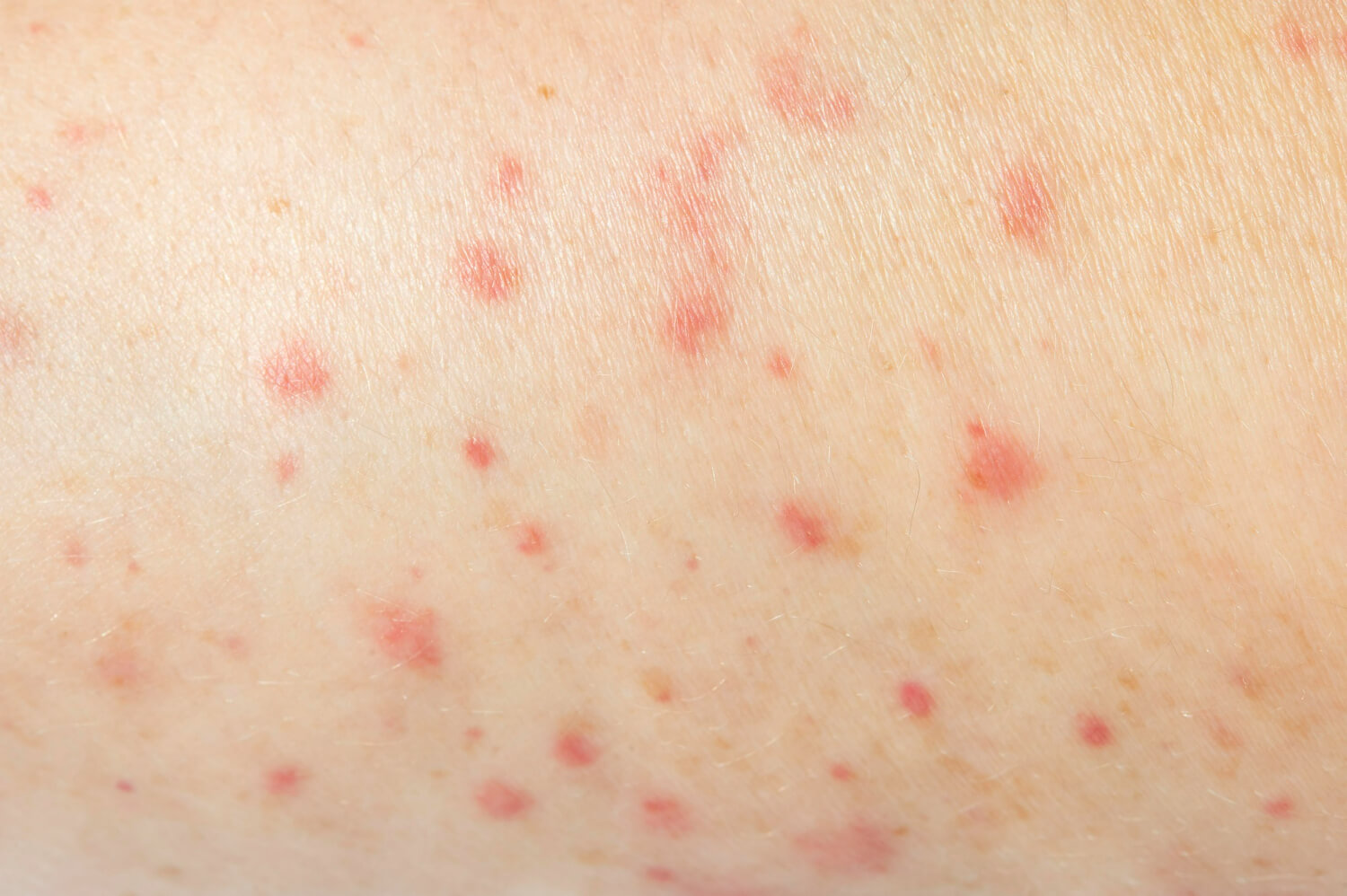 Simptomele infectiilor fungice Simptomele infectiilor fungice
